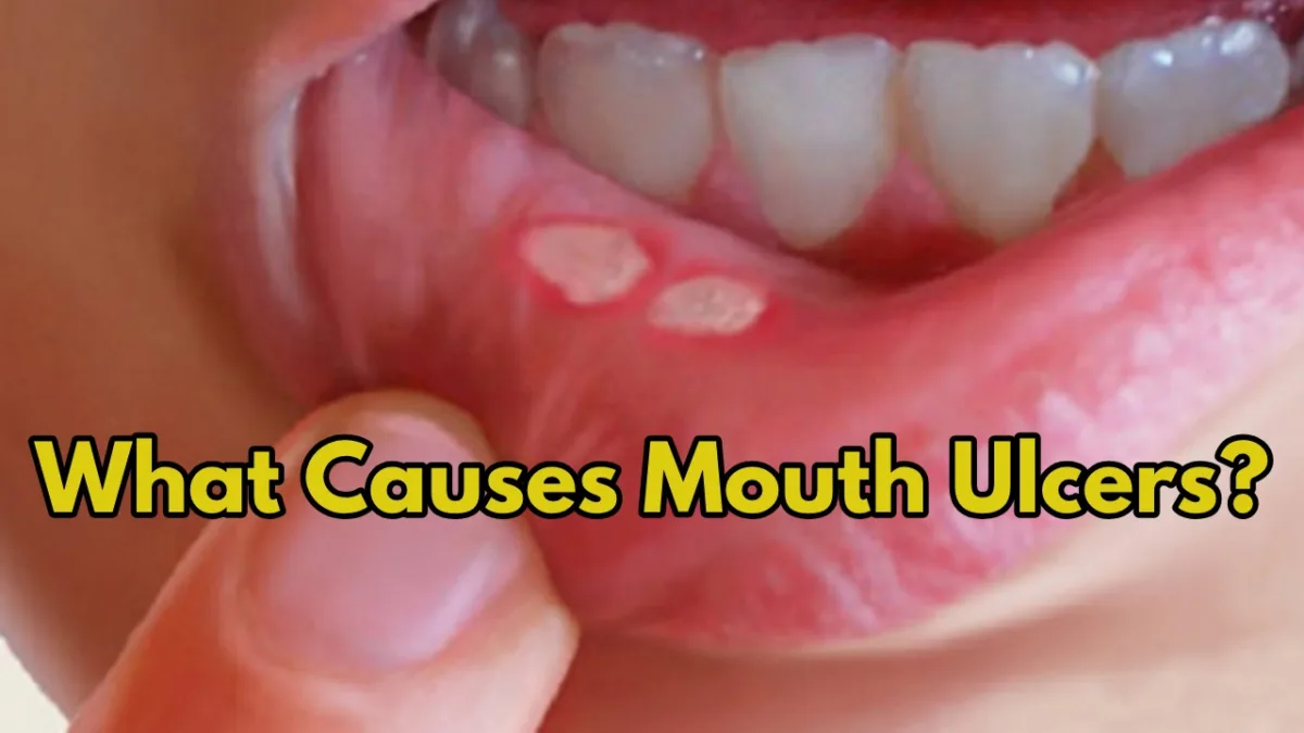 mouth ulcer