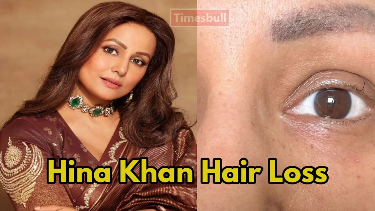 Hina Khan Hair Loss