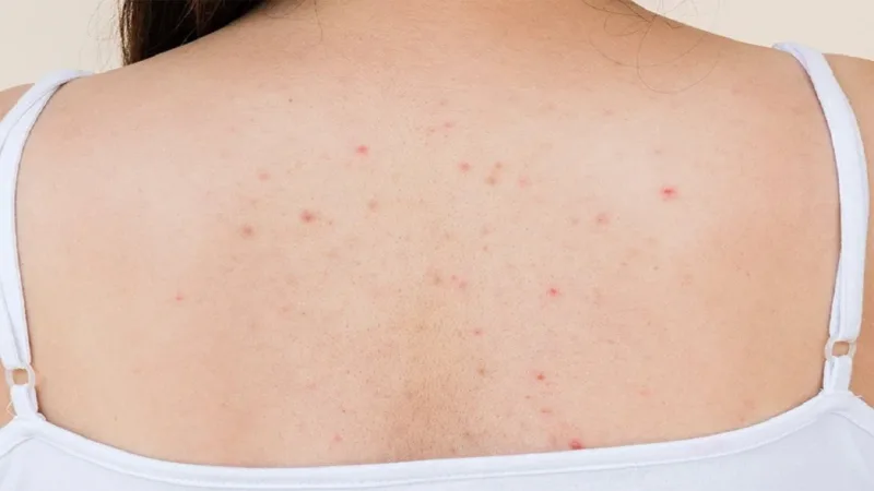 Pimples on the Back Why They Form and How to Remove Them