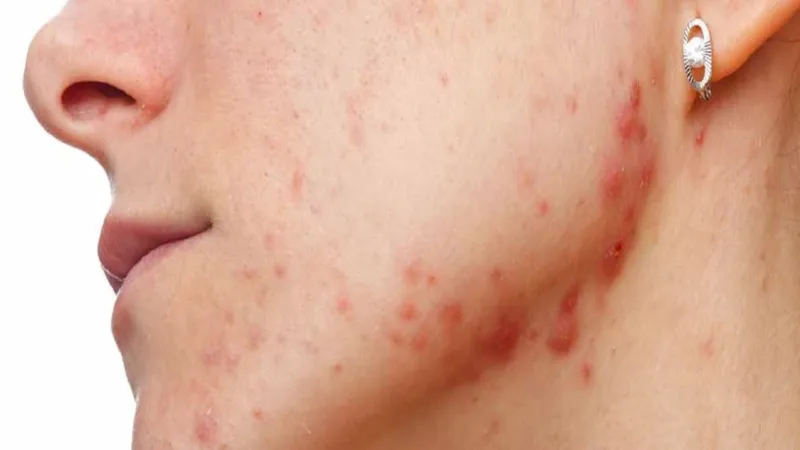 What is Cystic Acne Causes and How to Treat It